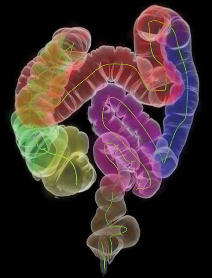 Montefiore CT Colonography